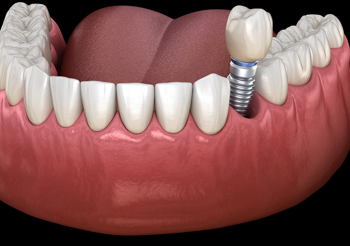 Dental Implant Restorations in London ON Area